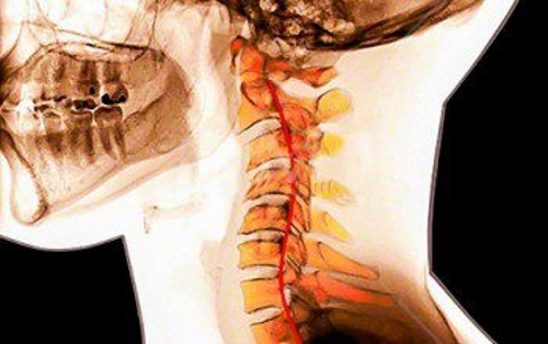 Что такое кифоз шейного отдела позвоночника?